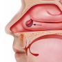 Current Management of Nasal Polyposis